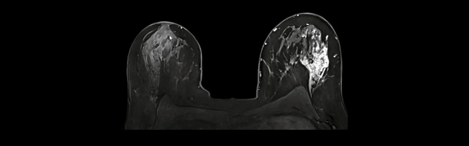 What Is The Purpose Of MR Mammography?
